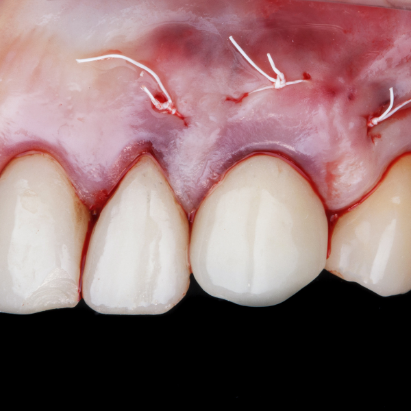 Immediate Implant Treatments