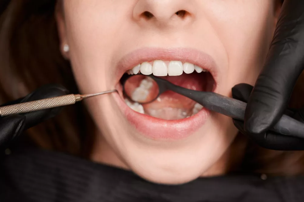 Wisdom Tooth Removal