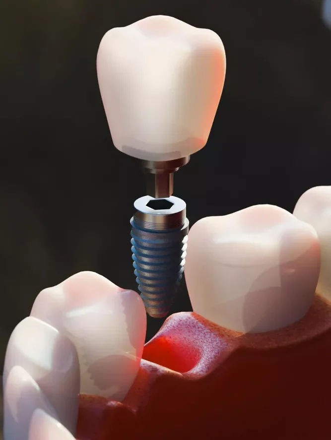 Dental Implant