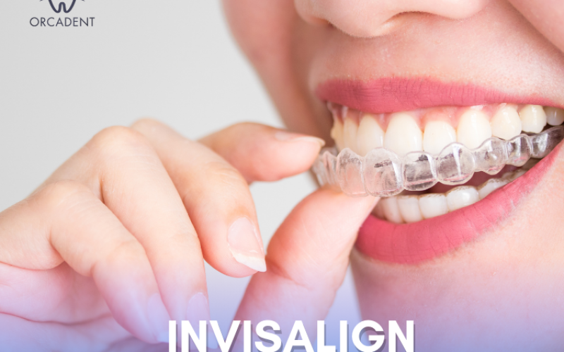 Invisalign